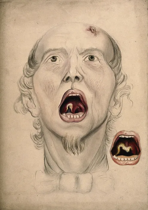 Framed Print : The face of a man, with mouth open wide, displaying a diseased area of tissue on the soft... 1866. Creator: Christopher D'Alton. The face of a man, with mouth open wide, displaying a diseased area of tissue on the soft... 1866