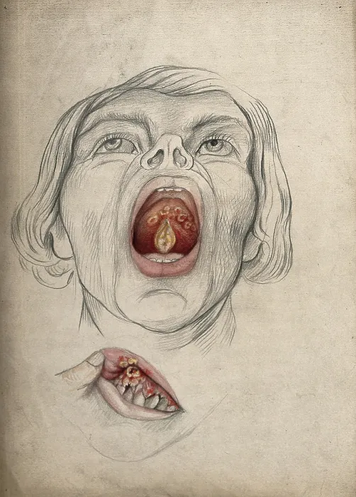 Framed Print : The face of a man, with mouth open wide, displaying diseased areas of... between 1800 and 1899. Creator: Christopher D'Alton. The face of a man, with mouth open wide, displaying diseased areas of... between 1800 and 1899 Framed Print : The face of a man, with mouth open wide, displaying diseased areas of... between 1800 and 1899. Creator: Christopher D'Alton. The face of a man, with mouth open wide, displaying diseased areas of... between 1800 and 1899