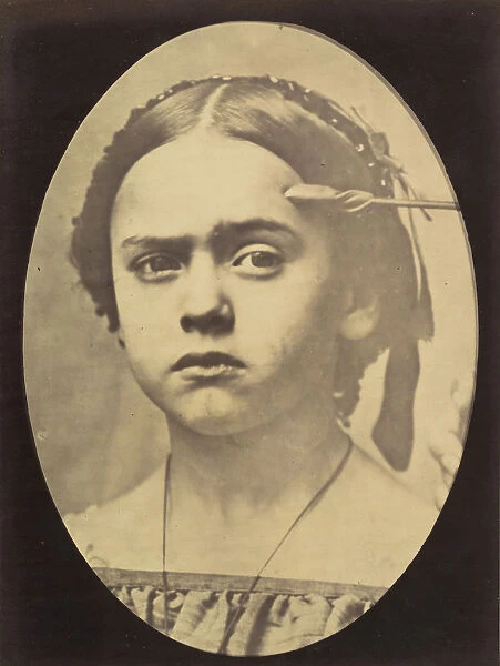 Figure 10: Showing the expressive lines of m. frontalis in a young girl, 1854-56