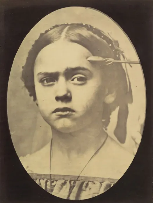 Framed Print : Figure 10: Showing the expressive lines of m. frontalis in a young girl, 1854-56 Framed Print : Figure 10: Showing the expressive lines of m. frontalis in a young girl, 1854-56