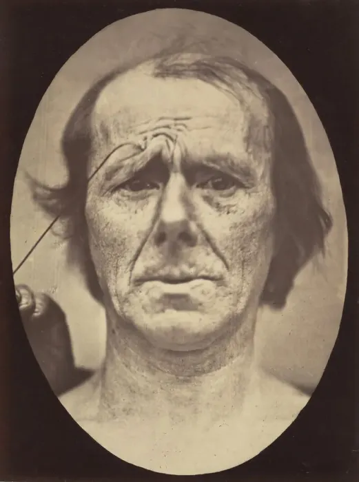 Framed Print : Figure 19: Suffering, 1854-56, printed 1862. Creators: Duchenne de Boulogne Framed Print : Figure 19: Suffering, 1854-56, printed 1862. Creators: Duchenne de Boulogne