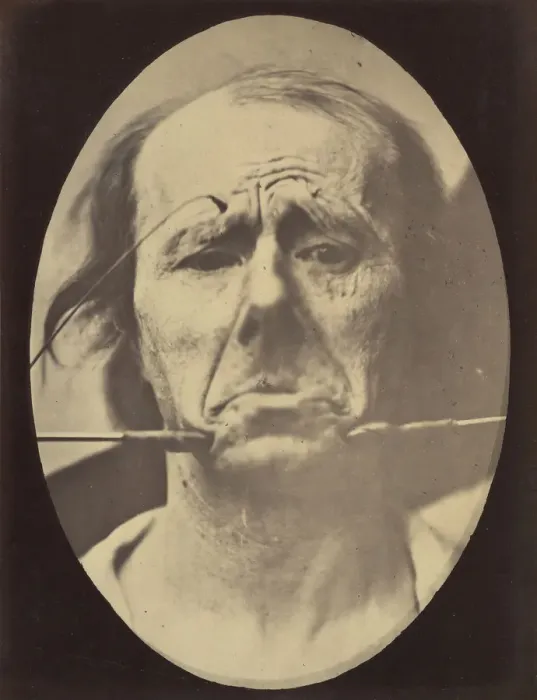 Framed Print : Figure 45: Pain and despair. 1854-56, printed 1862. Creators: Duchenne de Boulogne Framed Print : Figure 45: Pain and despair. 1854-56, printed 1862. Creators: Duchenne de Boulogne