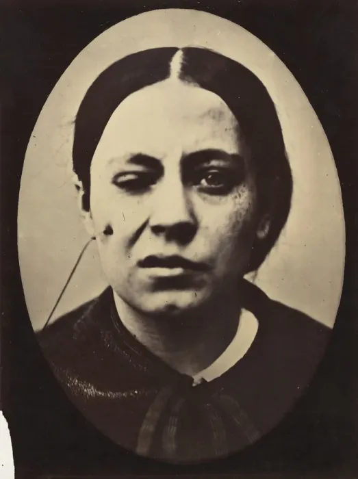 Framed Print : Figure 50: Affected weeping and face in repose, 1854-56, printed 1862