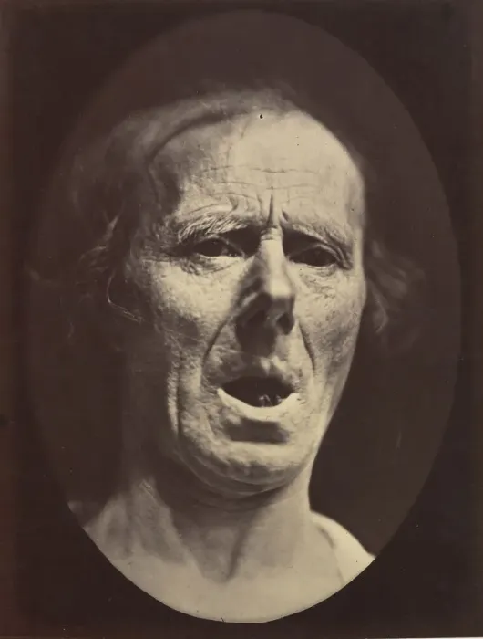 Framed Print : Figure 54: Voluntary lowering of the lower jaw, 1854-56, printed 1862 Framed Print : Figure 54: Voluntary lowering of the lower jaw, 1854-56, printed 1862