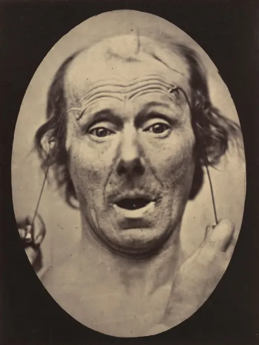 Framed Print : Figure 56: Surprise, 1854-56, printed 1862. Creators: Duchenne de Boulogne Framed Print : Figure 56: Surprise, 1854-56, printed 1862. Creators: Duchenne de Boulogne