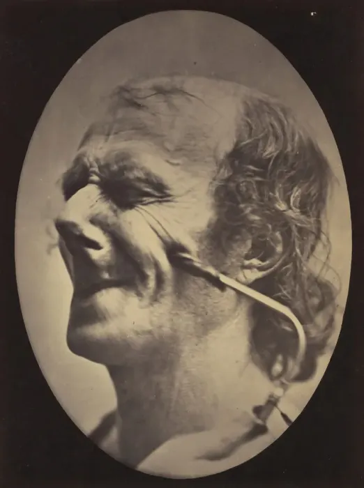 Framed Print : Figure 6: The grimace produced is similar to a tic of the face, 1854-56, printed 1862 Framed Print : Figure 6: The grimace produced is similar to a tic of the face, 1854-56, printed 1862