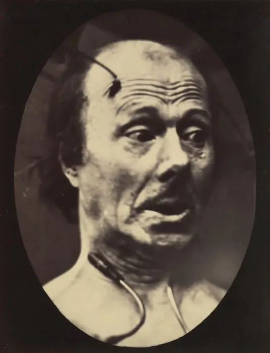 Framed Print : Figure 60: Fright, 1854-56, printed 1862. Creators: Duchenne de Boulogne Framed Print : Figure 60: Fright, 1854-56, printed 1862. Creators: Duchenne de Boulogne