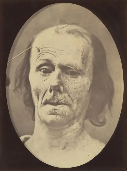 Framed Print : Figure 9: A study of m. frontalis in maximum contraction, 1854-56, printed 1862 Framed Print : Figure 9: A study of m. frontalis in maximum contraction, 1854-56, printed 1862