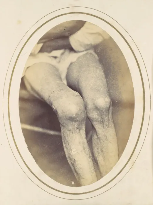 Framed Print : Frederick Hohmann, 1865. Creator: Reed Brockway Bontecou Framed Print : Frederick Hohmann, 1865. Creator: Reed Brockway Bontecou