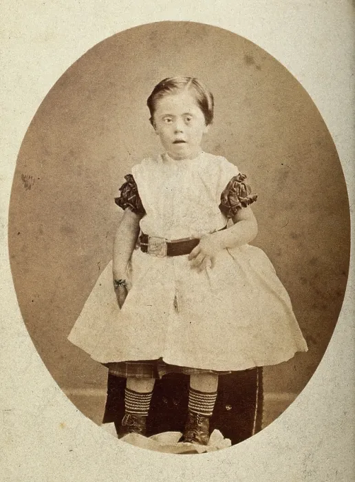 Framed Print : A girl with Down's syndrome, sitting, wearing striped socks, c1890s. Creator: Joseph Arthur Baldry. A girl with Down's syndrome, sitting, wearing striped socks, c1890s Framed Print : A girl with Down's syndrome, sitting, wearing striped socks, c1890s. Creator: Joseph Arthur Baldry. A girl with Down's syndrome, sitting, wearing striped socks, c1890s