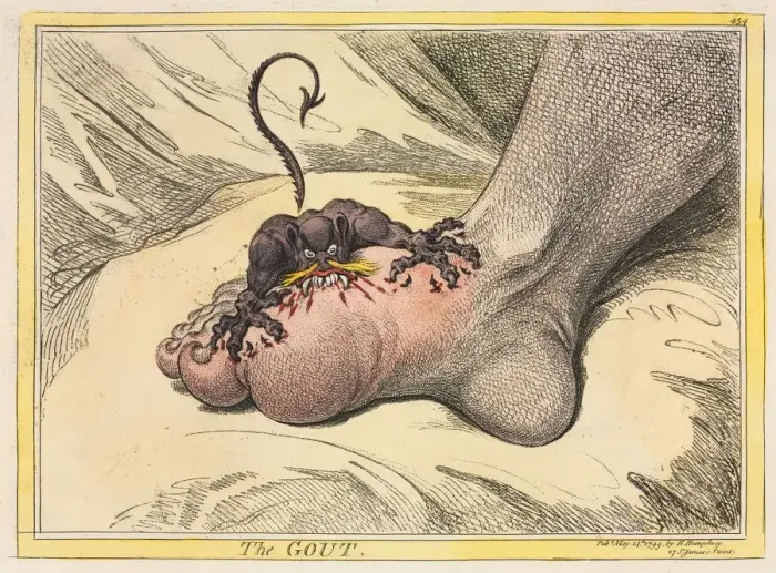 Framed Print : The Gout, 1799. Creator: James Gillray (British, 1757-1815); Hannah Humphrey Framed Print : The Gout, 1799. Creator: James Gillray (British, 1757-1815); Hannah Humphrey
