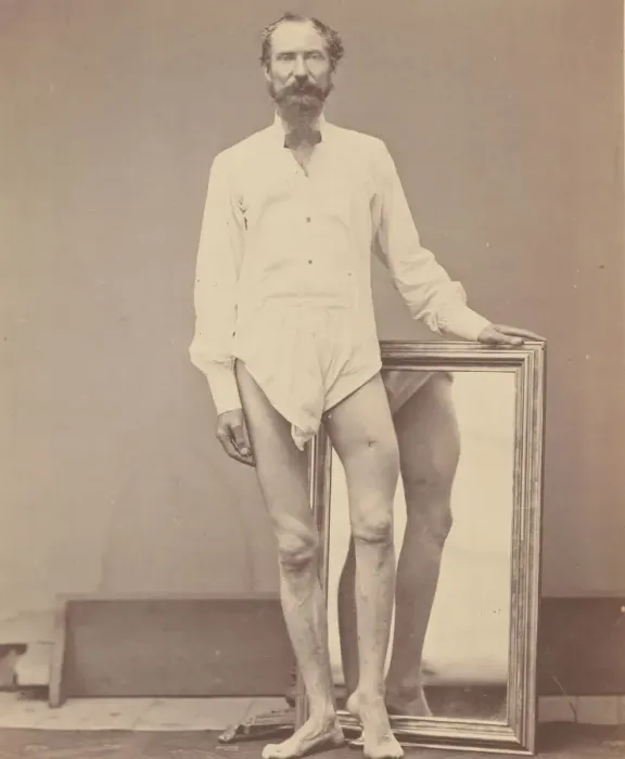 Framed Print : Gunshot Wound of Middle Third of Left Femur, 1865-67. Creator: William H. Bell Framed Print : Gunshot Wound of Middle Third of Left Femur, 1865-67. Creator: William H. Bell