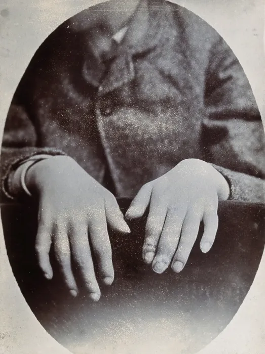 Framed Print : The hands of a child, showing deformity, particularly around the fingertips, c1890s. Creator: N. Goulton May Framed Print : The hands of a child, showing deformity, particularly around the fingertips, c1890s. Creator: N. Goulton May