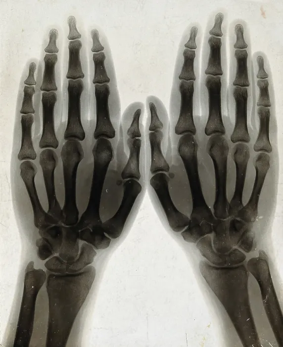 Framed Print : Two hands, viewed through x-ray, 1896 Framed Print : Two hands, viewed through x-ray, 1896