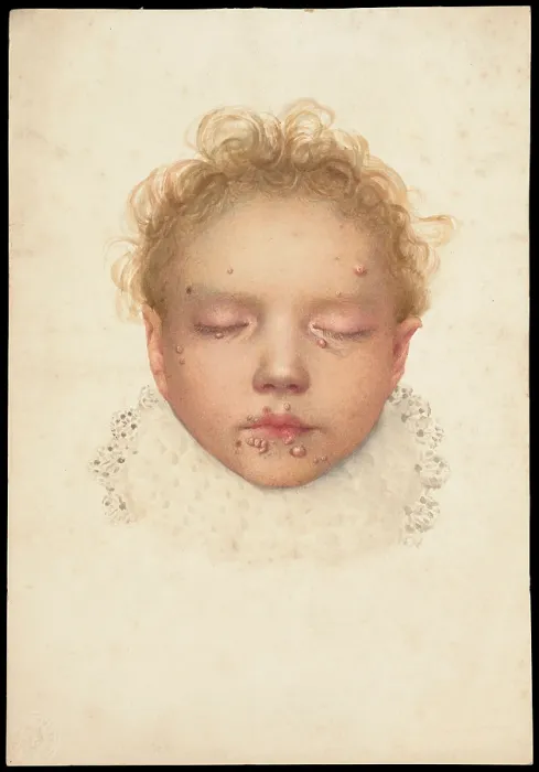 Framed Print : Head of a child with closed eyes and skin disease on the face, 1892. Creator: Unknown Framed Print : Head of a child with closed eyes and skin disease on the face, 1892. Creator: Unknown