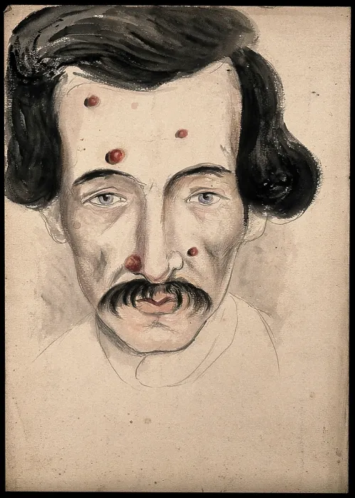 Framed Print : Head of a man with a disease affecting his face, 1800-1899. Creator: Christopher D'Alton. Head of a man with a disease affecting his face, 1800-1899. Creator: Christopher D'Alton Framed Print : Head of a man with a disease affecting his face, 1800-1899. Creator: Christopher D'Alton. Head of a man with a disease affecting his face, 1800-1899. Creator: Christopher D'Alton
