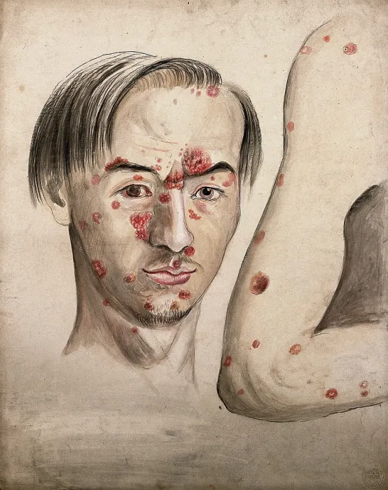 Framed Print : Head of a man with a severe disease affecting his face; and a section of diseased arm, 1800-1899. Creator: Christopher D'Alton. Head of a man with a severe disease affecting his face; and a section of diseased arm, 1800-1899 Framed Print : Head of a man with a severe disease affecting his face; and a section of diseased arm, 1800-1899. Creator: Christopher D'Alton. Head of a man with a severe disease affecting his face; and a section of diseased arm, 1800-1899