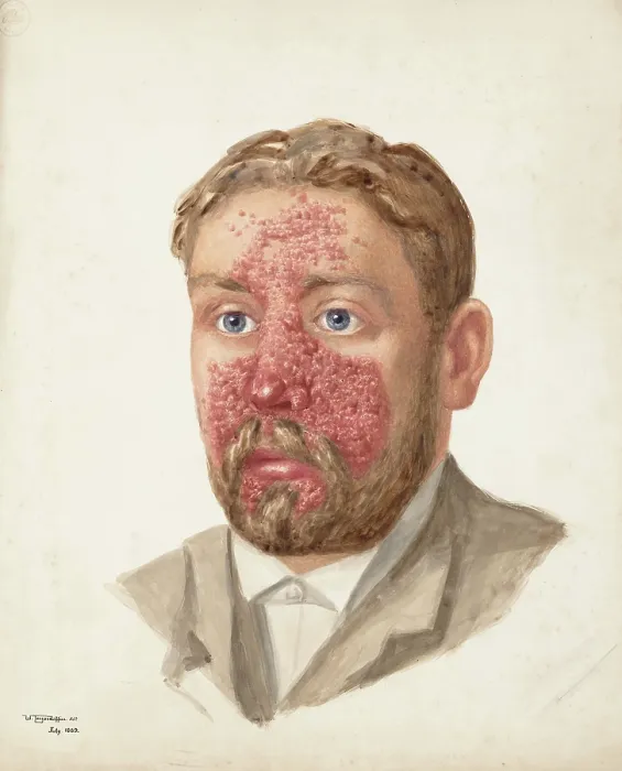 Framed Print : The head of a man with skin disease, July 1889. Creator: W Toogood Hill Framed Print : The head of a man with skin disease, July 1889. Creator: W Toogood Hill