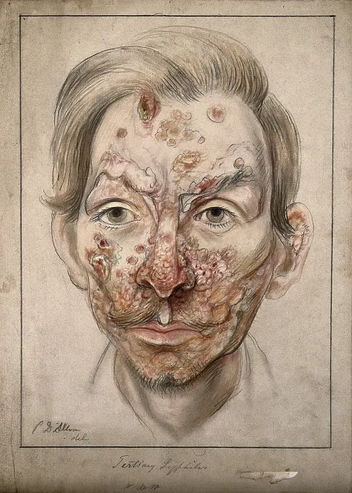 Framed Print : Head of a man with a syphilitic lesions affecting his face, 1874. Creator: Christopher D'Alton. Head of a man with a syphilitic lesions affecting his face, 1874. Creator: Christopher D'Alton Framed Print : Head of a man with a syphilitic lesions affecting his face, 1874. Creator: Christopher D'Alton. Head of a man with a syphilitic lesions affecting his face, 1874. Creator: Christopher D'Alton
