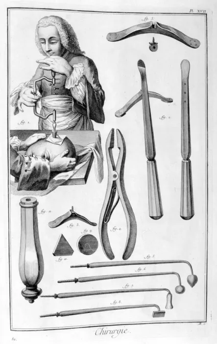 Framed Print : Head surgery, 1751-1777 Framed Print : Head surgery, 1751-1777