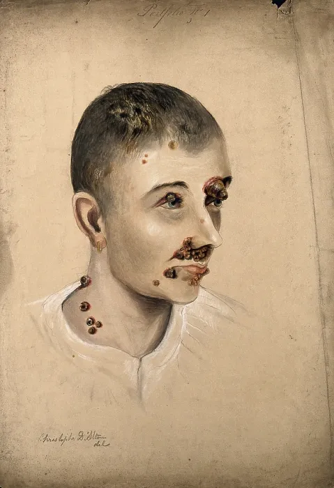 Framed Print : Head of a woman with a severe disease affecting her face and neck, 1864. Creator: Christopher D'Alton. Head of a woman with a severe disease affecting her face and neck, 1864. Creator: Christopher D'Alton Framed Print : Head of a woman with a severe disease affecting her face and neck, 1864. Creator: Christopher D'Alton. Head of a woman with a severe disease affecting her face and neck, 1864. Creator: Christopher D'Alton