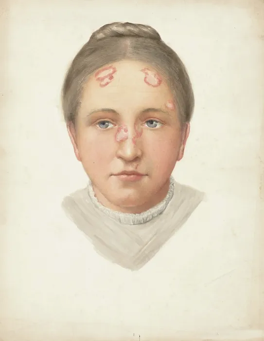 Framed Print : The head of a young woman with loss of skin on her forehead and nose, (1900?). Creator: Jonathan Hutchinson Framed Print : The head of a young woman with loss of skin on her forehead and nose, (1900?). Creator: Jonathan Hutchinson