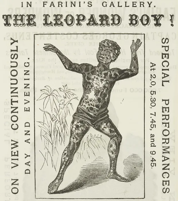 Framed Print : The Leopard Boy! in Farini's Gallery, 1881. Creator: Unknown. The Leopard Boy! in Farini's Gallery, 1881. Creator: Unknown Framed Print : The Leopard Boy! in Farini's Gallery, 1881. Creator: Unknown. The Leopard Boy! in Farini's Gallery, 1881. Creator: Unknown