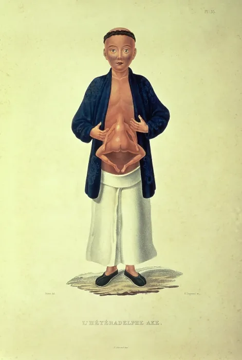 Framed Print : L'heteradelphe Ake, c1824-c1826. Creator: H Legrand. L'heteradelphe Ake, c1824-c1826. Creator: H Legrand Framed Print : L'heteradelphe Ake, c1824-c1826. Creator: H Legrand. L'heteradelphe Ake, c1824-c1826. Creator: H Legrand