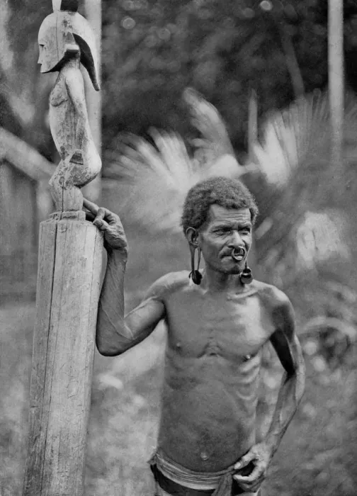 Framed Print : Malformation of the ears, Solomon Islands, 1920. Artist: JW Beattie Framed Print : Malformation of the ears, Solomon Islands, 1920. Artist: JW Beattie