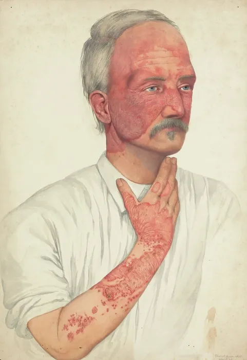 Framed Print : A man with disease designated as Lupus erythematosus, 1902. Creator: Mabel Green Framed Print : A man with disease designated as Lupus erythematosus, 1902. Creator: Mabel Green