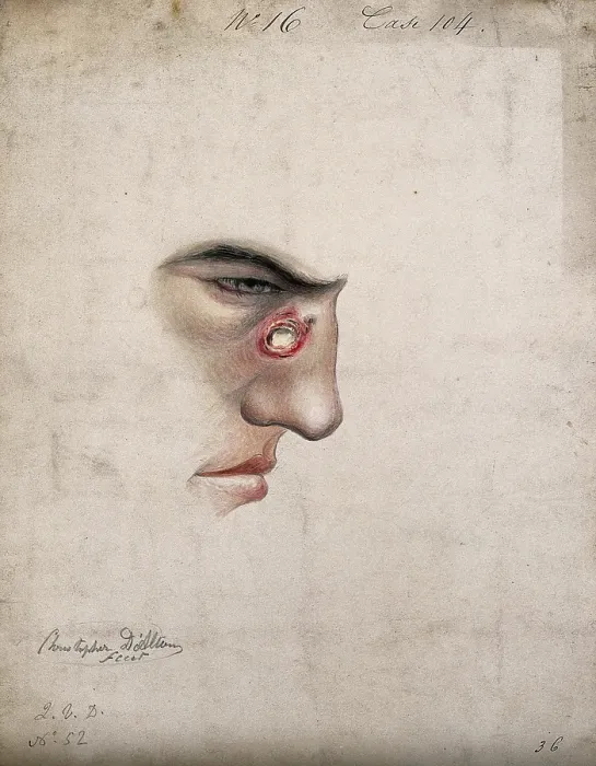 Framed Print : A detail of a man's face seen in profile with a severe disease affecting his nose, 1856. Creator: Christopher D'Alton. A detail of a man's face seen in profile with a severe disease affecting his nose, 1856. Creator: Christopher D'Alton Framed Print : A detail of a man's face seen in profile with a severe disease affecting his nose, 1856. Creator: Christopher D'Alton. A detail of a man's face seen in profile with a severe disease affecting his nose, 1856. Creator: Christopher D'Alton