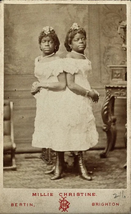 Framed Print : The Millie-Christine sisters, conjoined twins, standing, 1874. Creator: Bertin Framed Print : The Millie-Christine sisters, conjoined twins, standing, 1874. Creator: Bertin