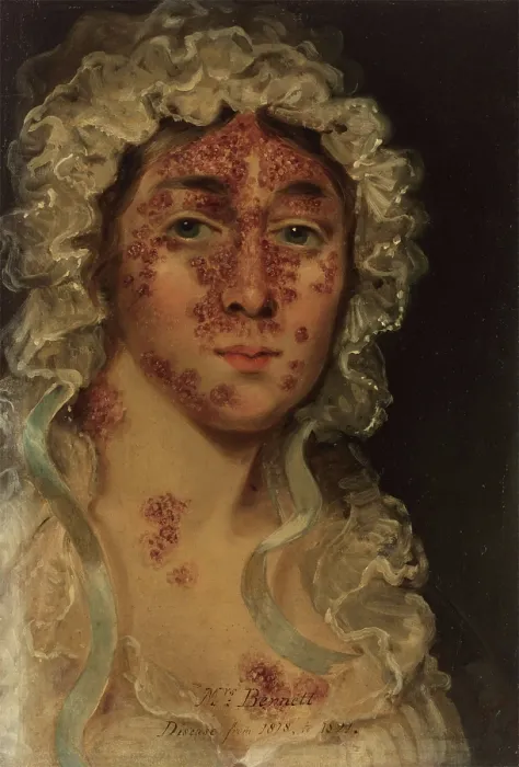 Framed Print : Mrs Bennett, afflicted with a skin disease, between 1818 and 1821. Creator: Unknown Framed Print : Mrs Bennett, afflicted with a skin disease, between 1818 and 1821. Creator: Unknown