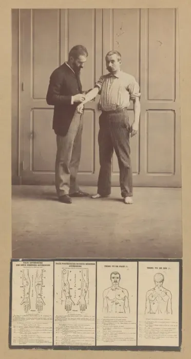 Framed Print : Notation of Scars, Schematic Drawings, ca. 1893. Creator: Alphonse Bertillon Framed Print : Notation of Scars, Schematic Drawings, ca. 1893. Creator: Alphonse Bertillon