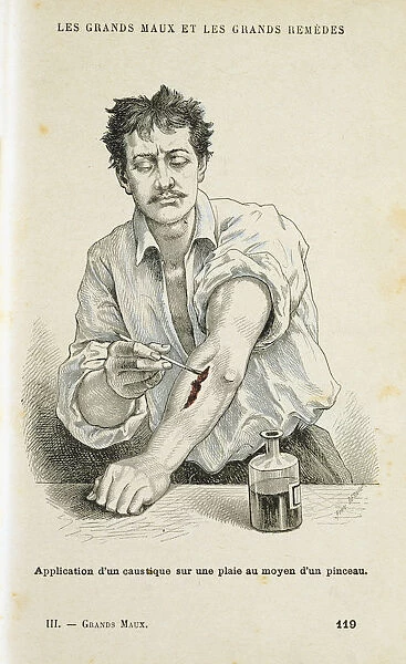 Painting a wound with an antiseptic solution, c1890