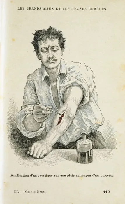 Framed Print : Painting a wound with an antiseptic solution, c1890 Framed Print : Painting a wound with an antiseptic solution, c1890