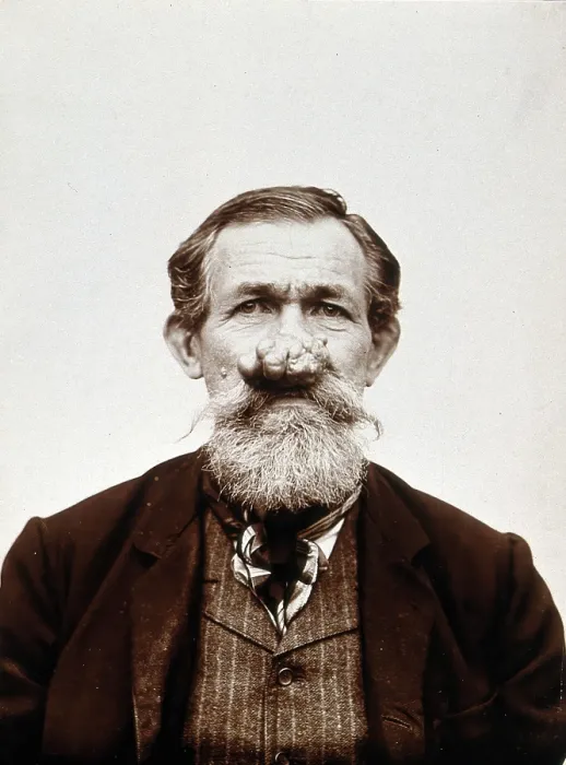 Framed Print : A patient of Leon Desguin, before operation, c1890s. Creator: Unknown Framed Print : A patient of Leon Desguin, before operation, c1890s. Creator: Unknown