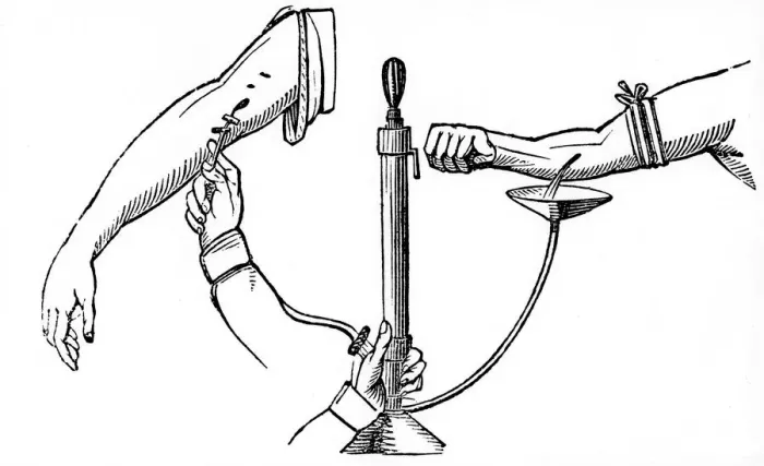 Framed Print : Person-to person blood transfusion, 1833 Framed Print : Person-to person blood transfusion, 1833