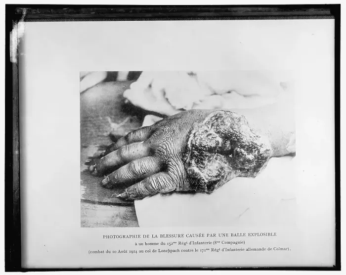Framed Print : Photographie de la blessure causée par une balle explosible... 1914. Creator: Harris & Ewing. Photographie de la blessure causée par une balle explosible... 1914. Creator: Harris & Ewing Framed Print : Photographie de la blessure causée par une balle explosible... 1914. Creator: Harris & Ewing. Photographie de la blessure causée par une balle explosible... 1914. Creator: Harris & Ewing