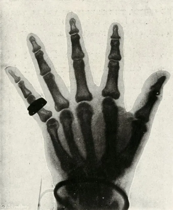 Framed Print : Radiograph of the Hand of H. R. H. The Prince of Wales, (c1897) Framed Print : Radiograph of the Hand of H. R. H. The Prince of Wales, (c1897)