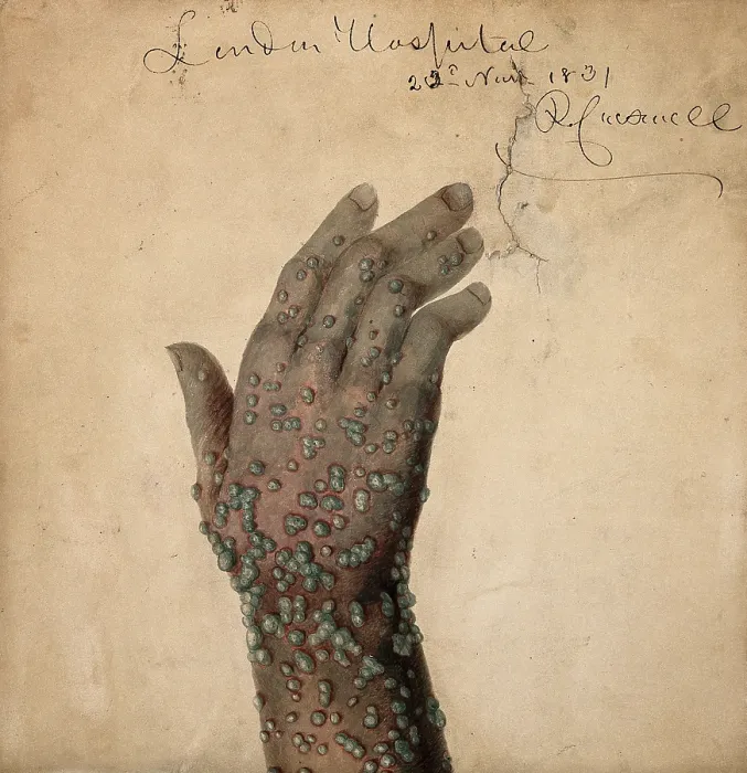 Framed Print : Rash of pustules on the hand of a patient, probably suffering from smallpox, 1831. Creator: Robert Carswell Framed Print : Rash of pustules on the hand of a patient, probably suffering from smallpox, 1831. Creator: Robert Carswell