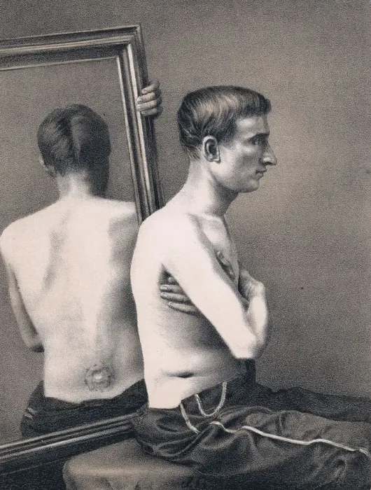 Framed Print : Recovering casualty of a bullet wound to the abdomen, American Civil War, 1865 Framed Print : Recovering casualty of a bullet wound to the abdomen, American Civil War, 1865