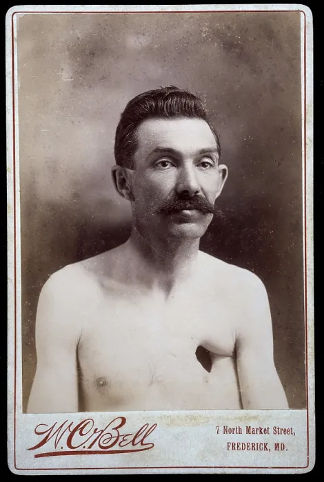 Framed Print : Reverend Eavens, a man with a hole in his chest, between 1800 and 1899. Creator: WC Bell Framed Print : Reverend Eavens, a man with a hole in his chest, between 1800 and 1899. Creator: WC Bell