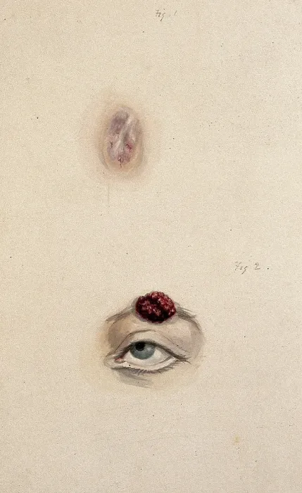 Framed Print : A section of a child's diseased forehead (detail); and a child's diseased eyebrow... 1829. Creator: Unknown. A section of a child's diseased forehead (detail); and a child's diseased eyebrow... 1829. Creator: Unknown Framed Print : A section of a child's diseased forehead (detail); and a child's diseased eyebrow... 1829. Creator: Unknown. A section of a child's diseased forehead (detail); and a child's diseased eyebrow... 1829. Creator: Unknown