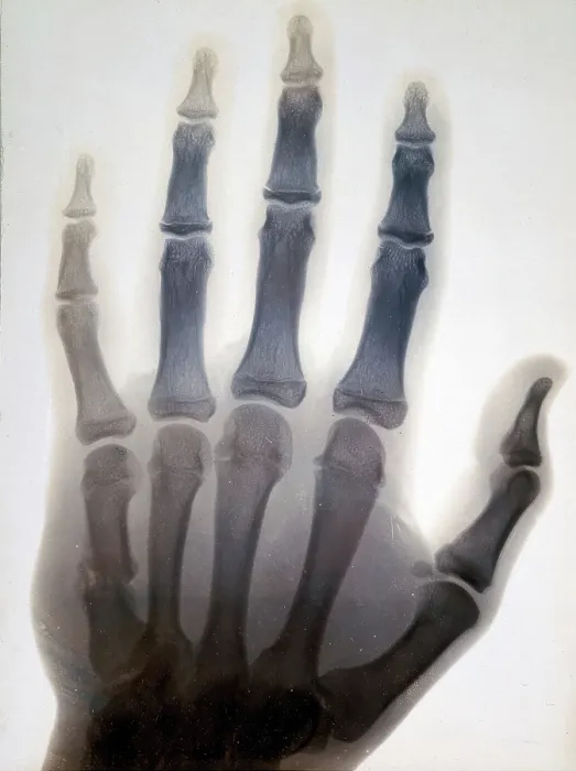 Framed Print : Sir Gervas Powell Glyn, 6th Bart: radiograph of his hand, 1896. Creator: Sir GP Glyn Framed Print : Sir Gervas Powell Glyn, 6th Bart: radiograph of his hand, 1896. Creator: Sir GP Glyn