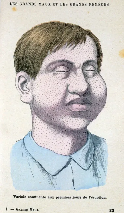 Framed Print : Smallpox victim, c1890 Framed Print : Smallpox victim, c1890