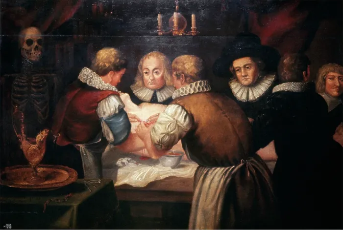 Framed Print : Surgeons performing an operation on a woman's breast in the seventeenth century. Creator: Unknown. Surgeons performing an operation on a woman's breast in the seventeenth century. Creator: Unknown Framed Print : Surgeons performing an operation on a woman's breast in the seventeenth century. Creator: Unknown. Surgeons performing an operation on a woman's breast in the seventeenth century. Creator: Unknown