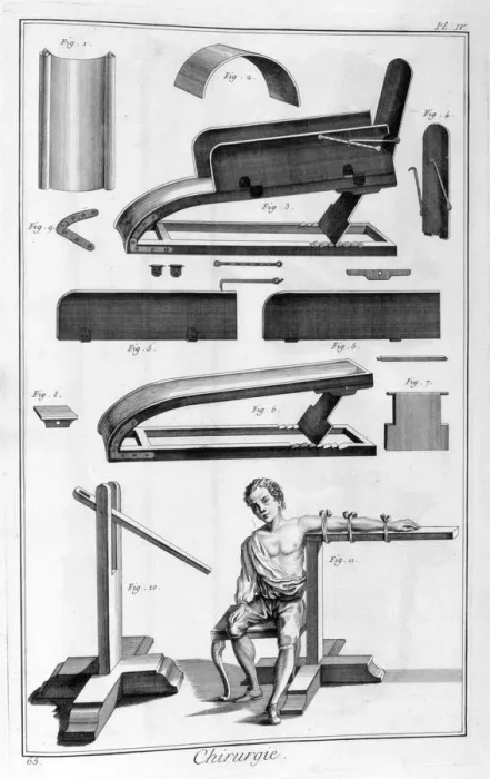 Framed Print : Surgery, 1751-1777 Framed Print : Surgery, 1751-1777