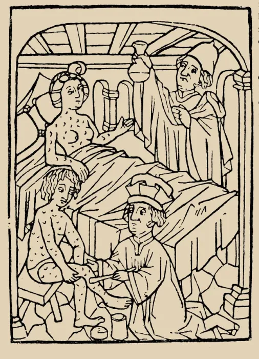 Framed Print : Syphilis treatment: Treatment with ointments (mercury). From: A Malafranczos morbo gallorum preserv Framed Print : Syphilis treatment: Treatment with ointments (mercury). From: A Malafranczos morbo gallorum preserv