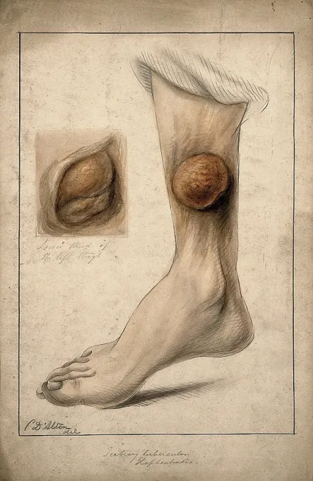 Framed Print : Tertiary tubercular elephantiasis on the thigh and calf of a woman, 1874. Creator: Christopher D'Alton. Tertiary tubercular elephantiasis on the thigh and calf of a woman, 1874. Creator: Christopher D'Alton Framed Print : Tertiary tubercular elephantiasis on the thigh and calf of a woman, 1874. Creator: Christopher D'Alton. Tertiary tubercular elephantiasis on the thigh and calf of a woman, 1874. Creator: Christopher D'Alton